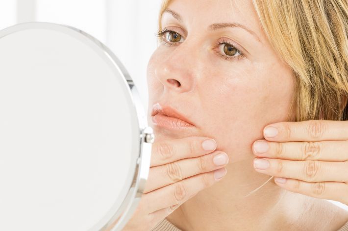 Menopause and acne