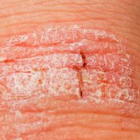 what causes psoriasis and how do you treat it
