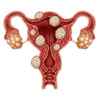 Suffering from fibroids?