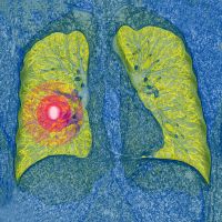 the symptoms, risks and types of lung cancer