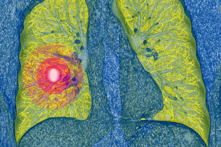 the symptoms, risks and types of lung cancer