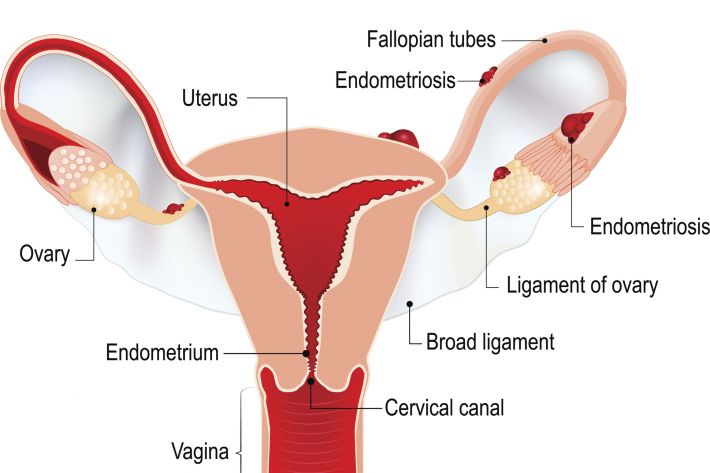 What does Endometriosis look like?