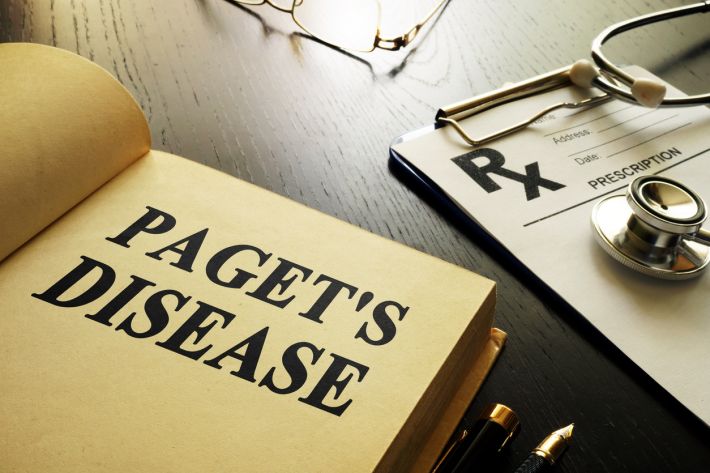 What is Paget's disease?
