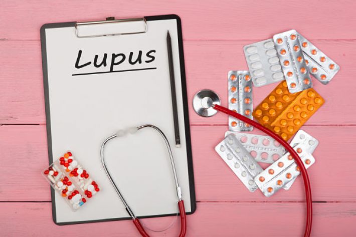 The signs, symptoms and treatment of Lupus