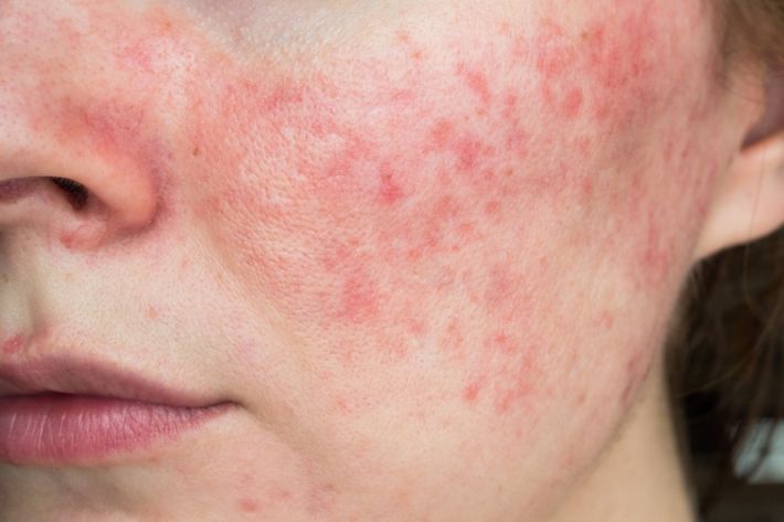 common rosacea triggers