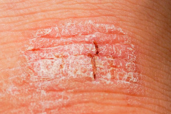 what causes psoriasis and how do you treat it