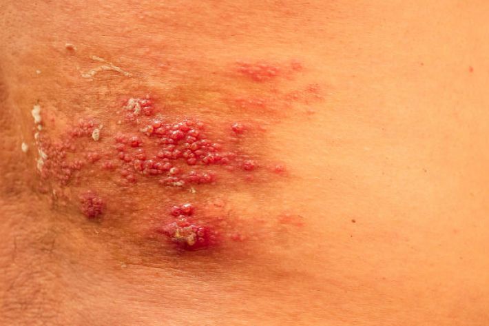 Typical symptoms of shingles