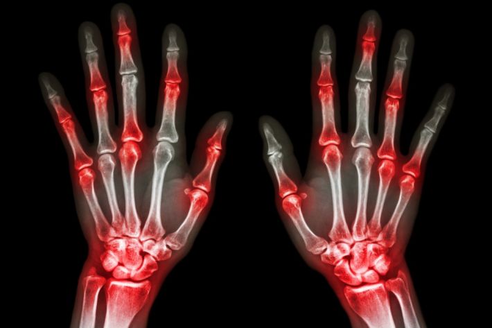 An explanation of arthritis conditions