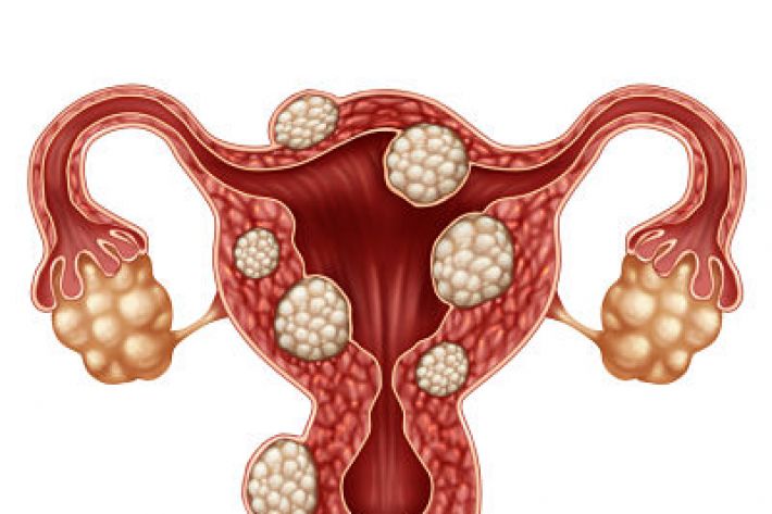 Suffering from fibroids?