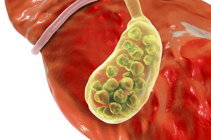 Why do gallstones happen?