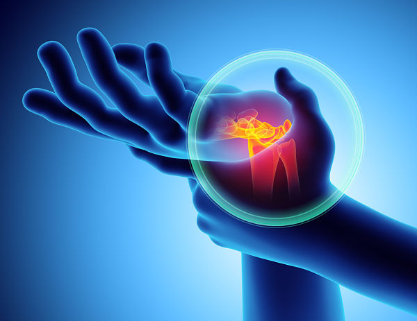Carpal-tunnel-syndrome