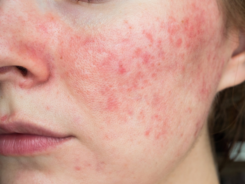 common rosacea triggers