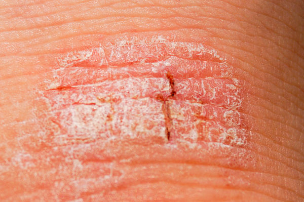what causes psoriasis and how do you treat it