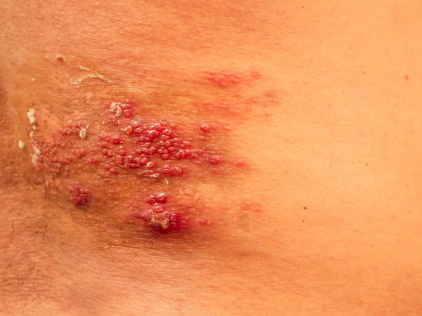 Typical symptoms of shingles