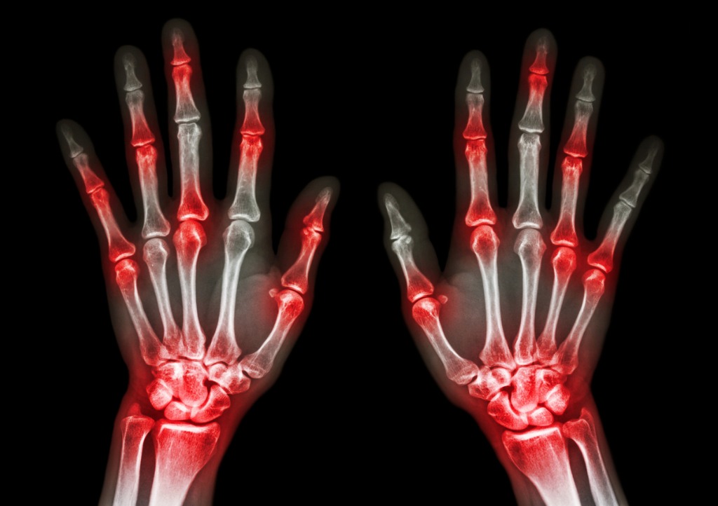 An explanation of arthritis conditions